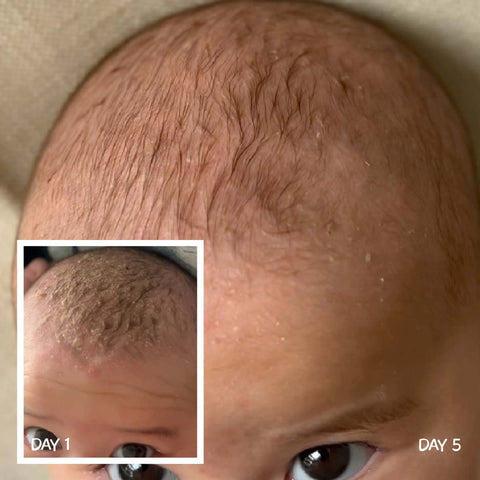 Before and after comparison of cradle cap on a baby's scalp, with 'Day 1' and 'Day 5' insets.