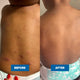 Before and after comparison of a child's back with visible improvements.