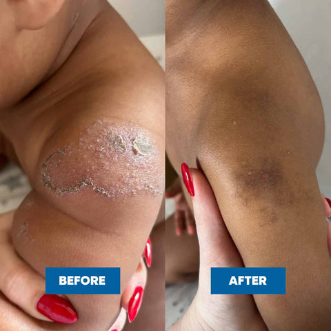 Before and after comparison of a child's arm with visible skin conditions.