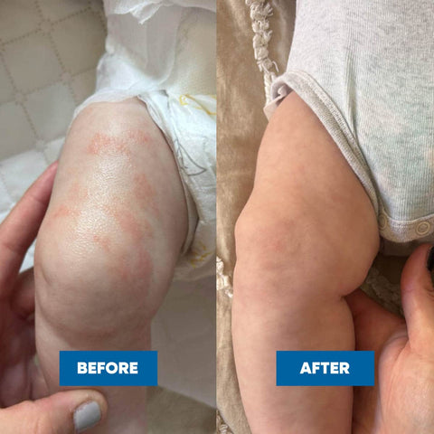 Before and after comparison of a child's knee with eczema, showing improvement.