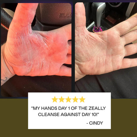 Hand before and after using Zeally Herbs Intestinal Parasite Cleanse with text overlay and star rating.